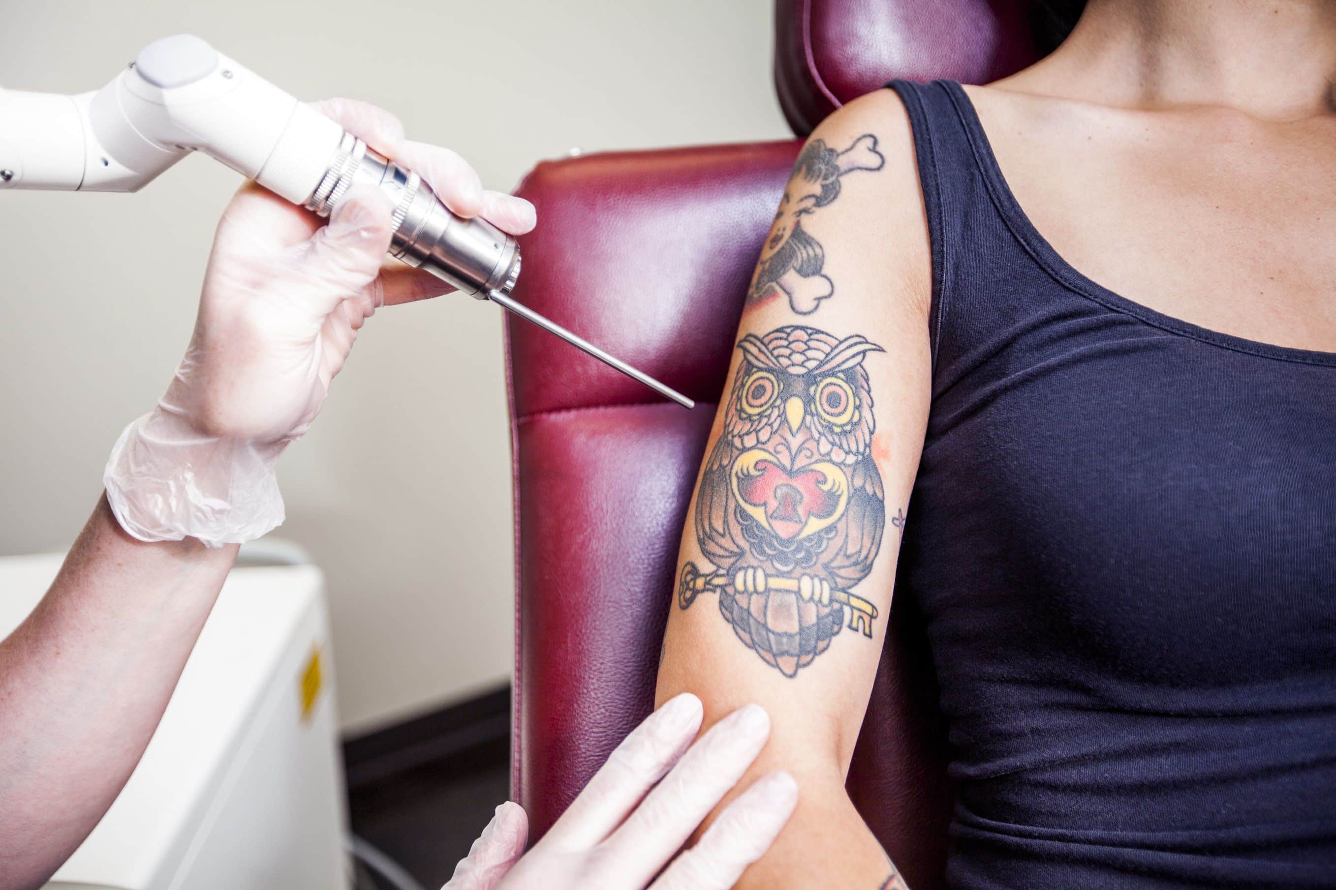winterpark tattoo removal facts