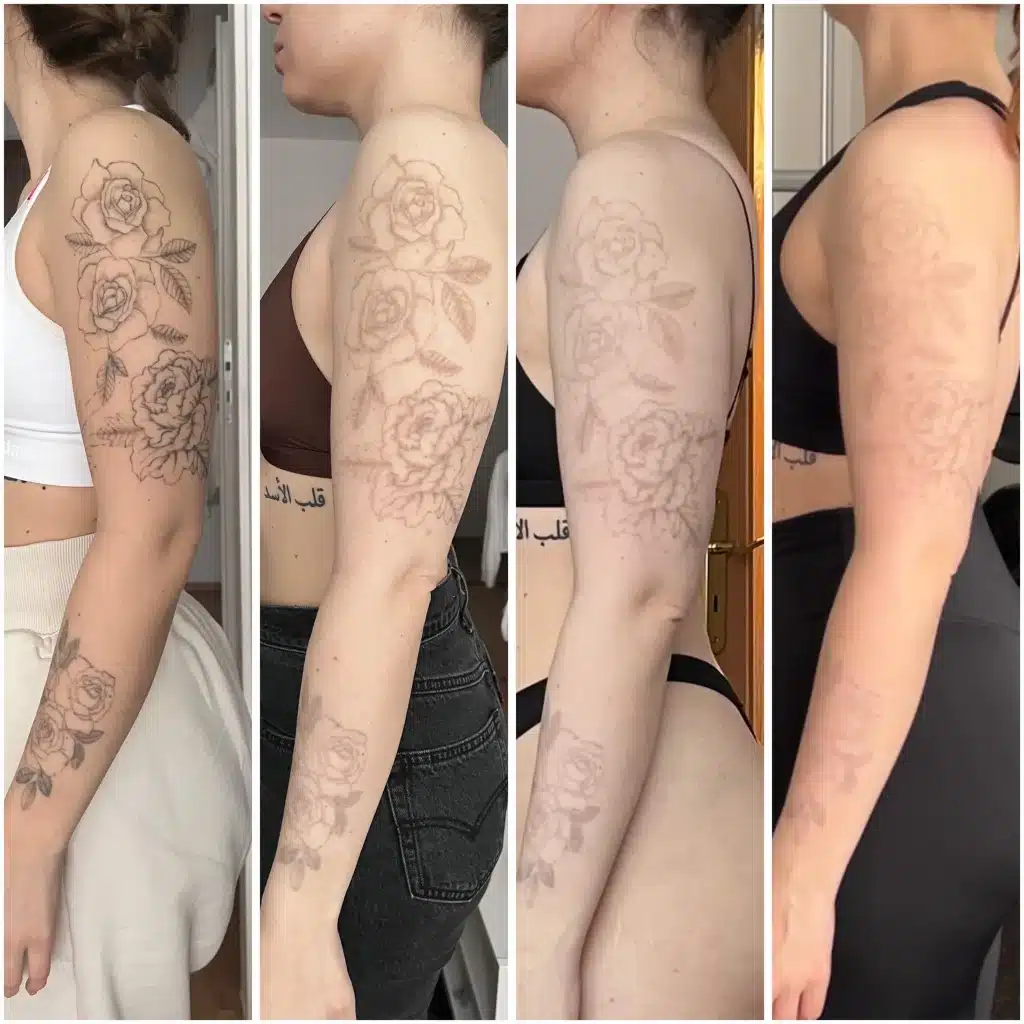 Tattoo Removal After Pictures