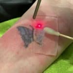 patch laser tattoo removal