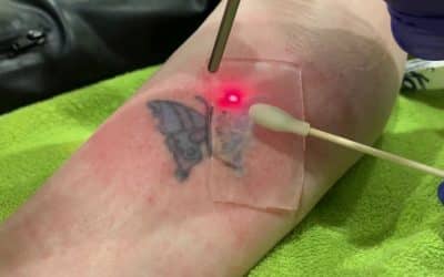 Ink, Time, and the Choice to Begin Again | Patch laser tattoo removal