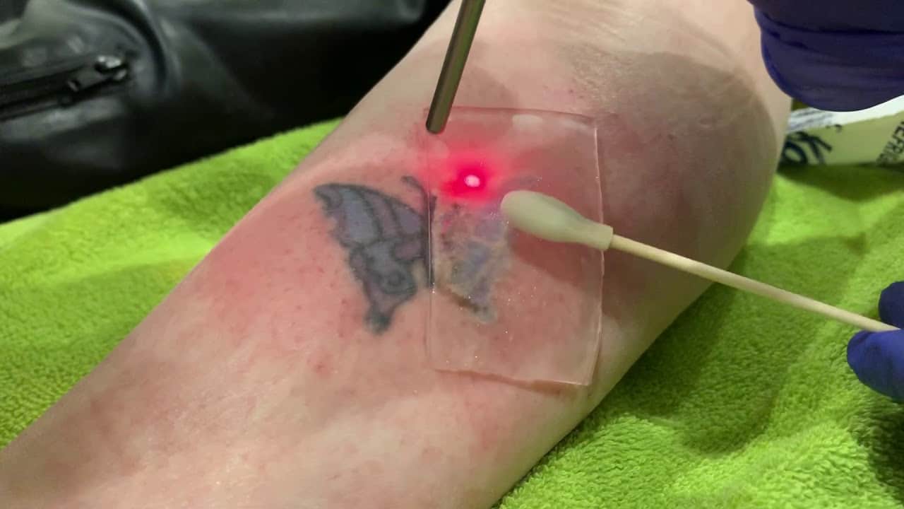 patch laser tattoo removal