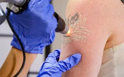 No Scar Tattoo Removal: Advanced Laser Treatment for Safe and Effective Ink Removal