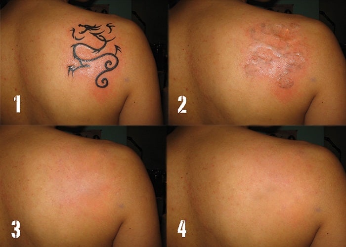 No Scar Tattoo Removal