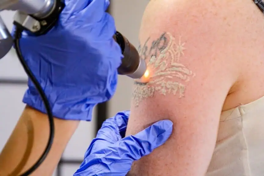 No Scar Tattoo Removal: Advanced Laser Treatment for Safe and Effective Ink Removal