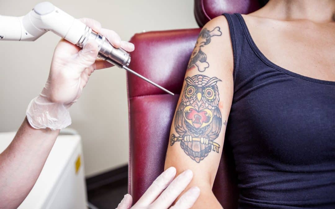 Effective Tattoo Removal: The Best Methods for Smooth, Clear Skin