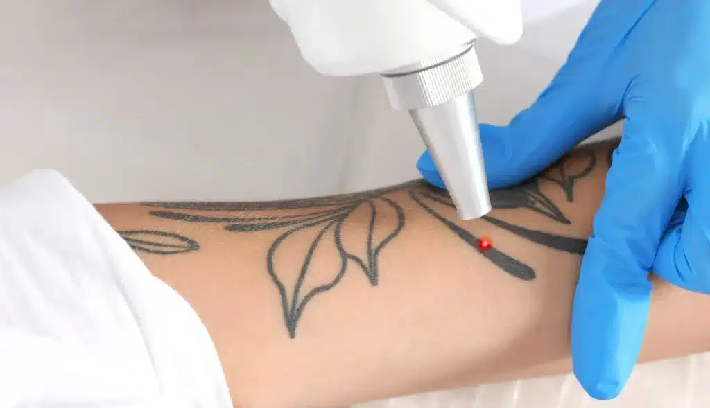 laser tattoo removal shop