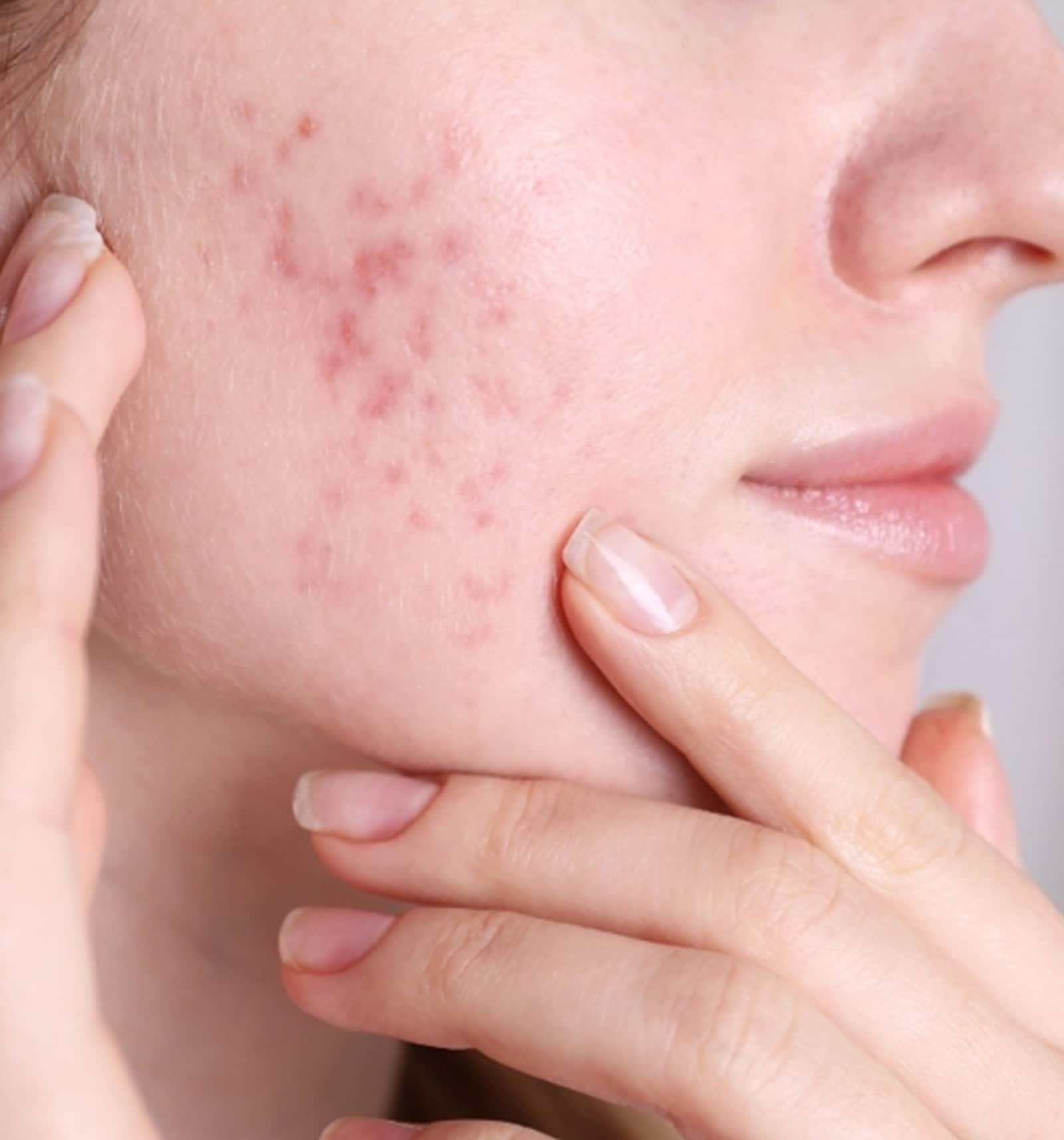 Tattoo Removal for Acne Scar Treatment