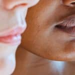 tattoo removal dark skin orlando