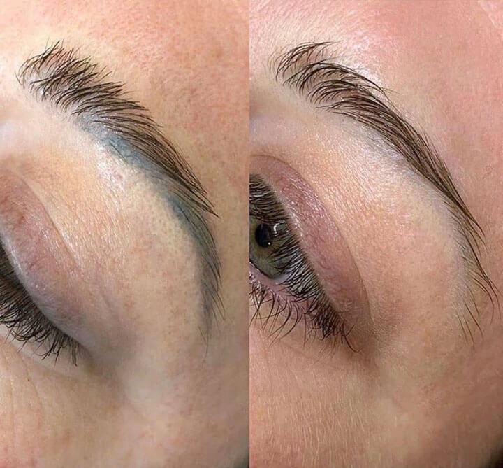 Can You Remove Bad Microblading?