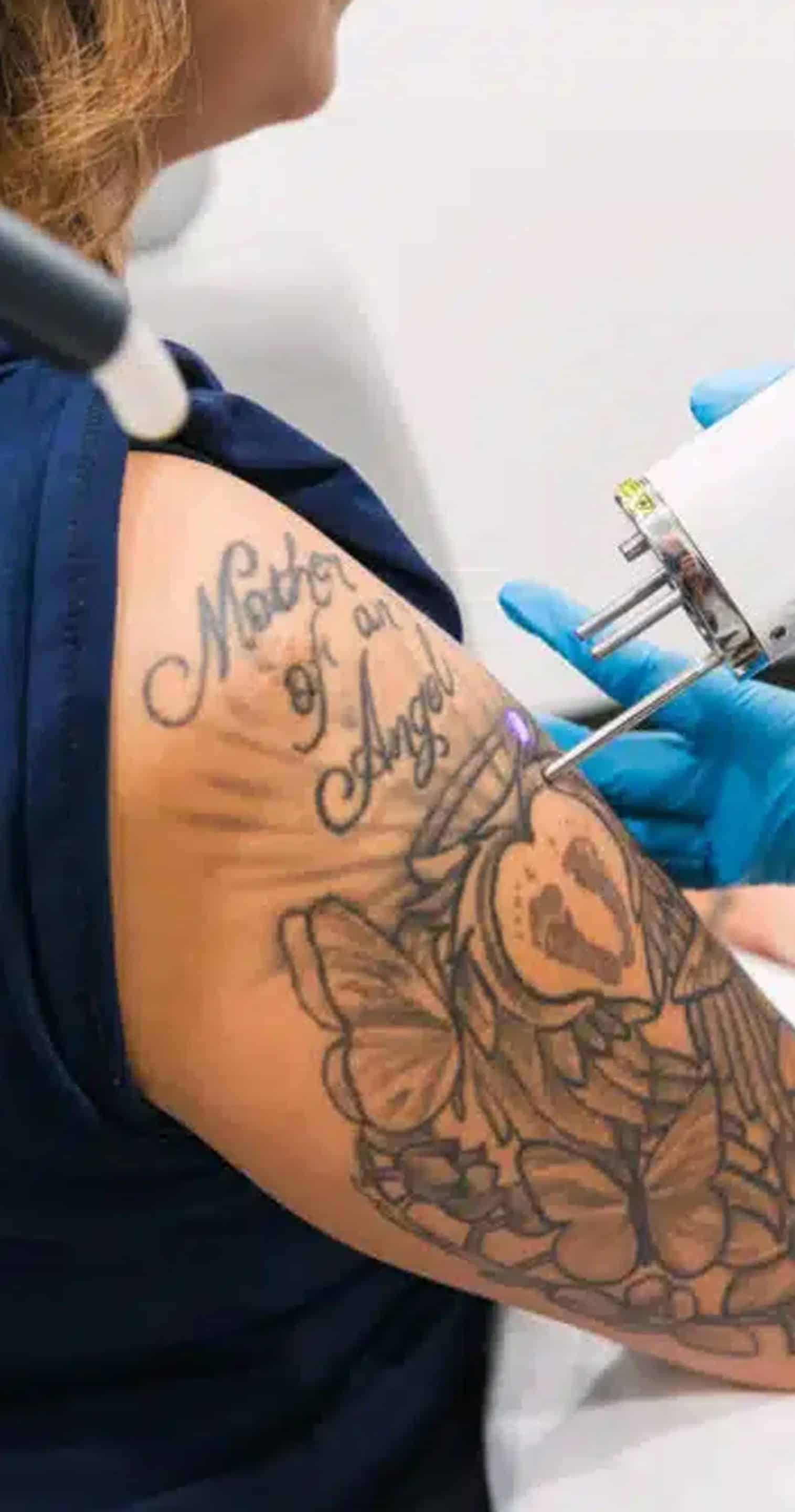 PFD Patch Laser Tattoo Removal