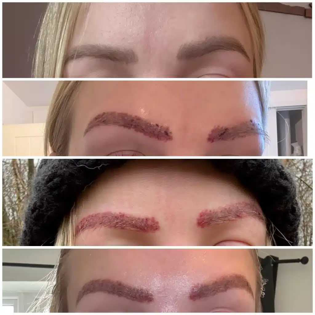 bad microblading removal