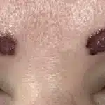 bad microblading removal