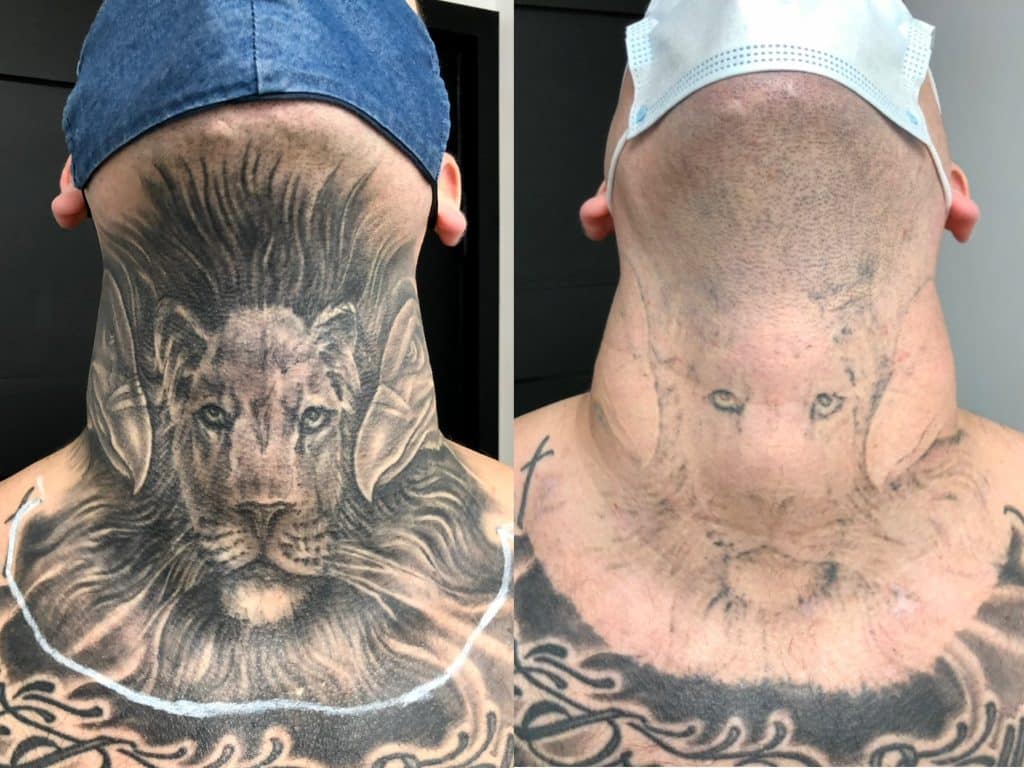 how many sessions does laser tattoo removal take?