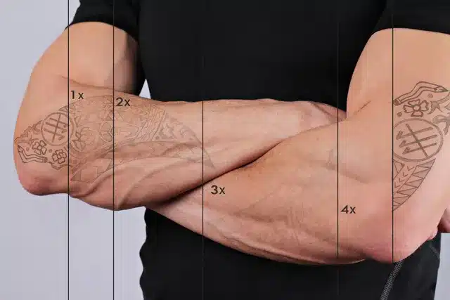 how many sessions does laser tattoo removal take?