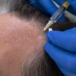 scalp micropigmentation for hair loss
