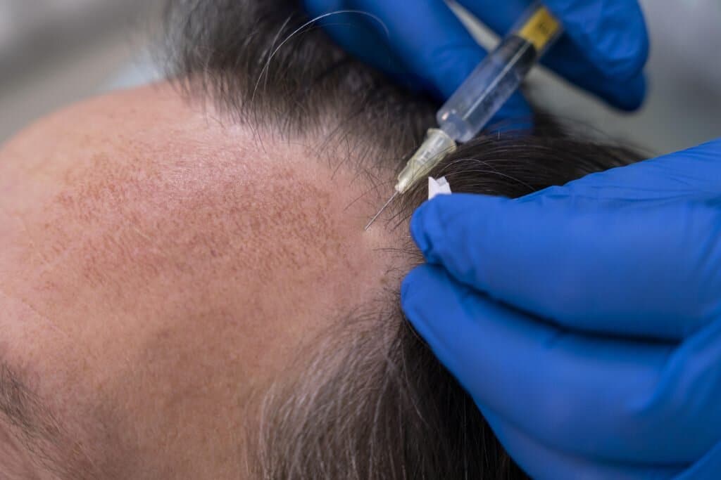 scalp micropigmentation for hair loss
