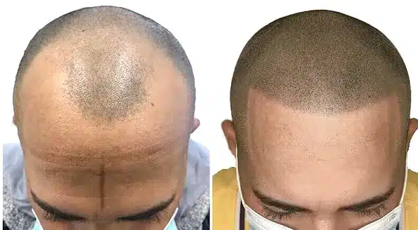 scalp micropigmentation for hair loss