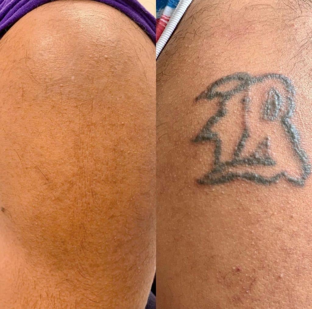 tattoo removal for fitzpatrick IV–VI skin