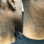 tattoo removal for fitzpatrick IV–VI skin