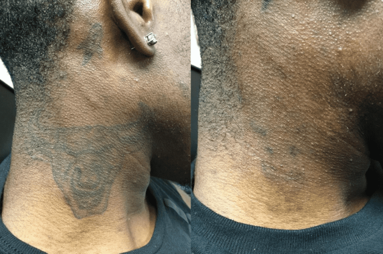 tattoo removal for fitzpatrick IV–VI skin