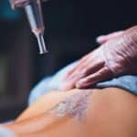 Does Tattoo Removal Hurt? What to Really Expect