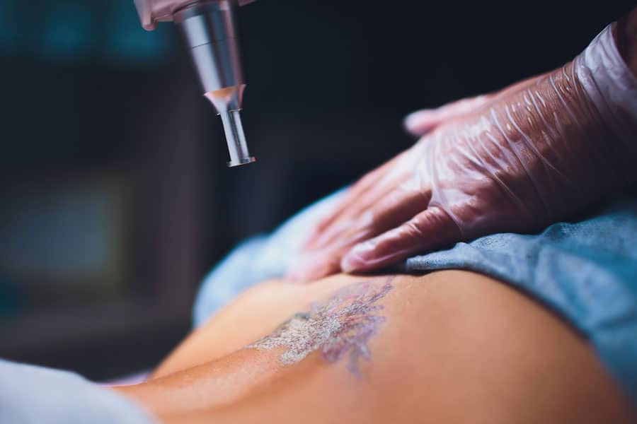 Does Tattoo Removal Hurt? What to Really Expect
