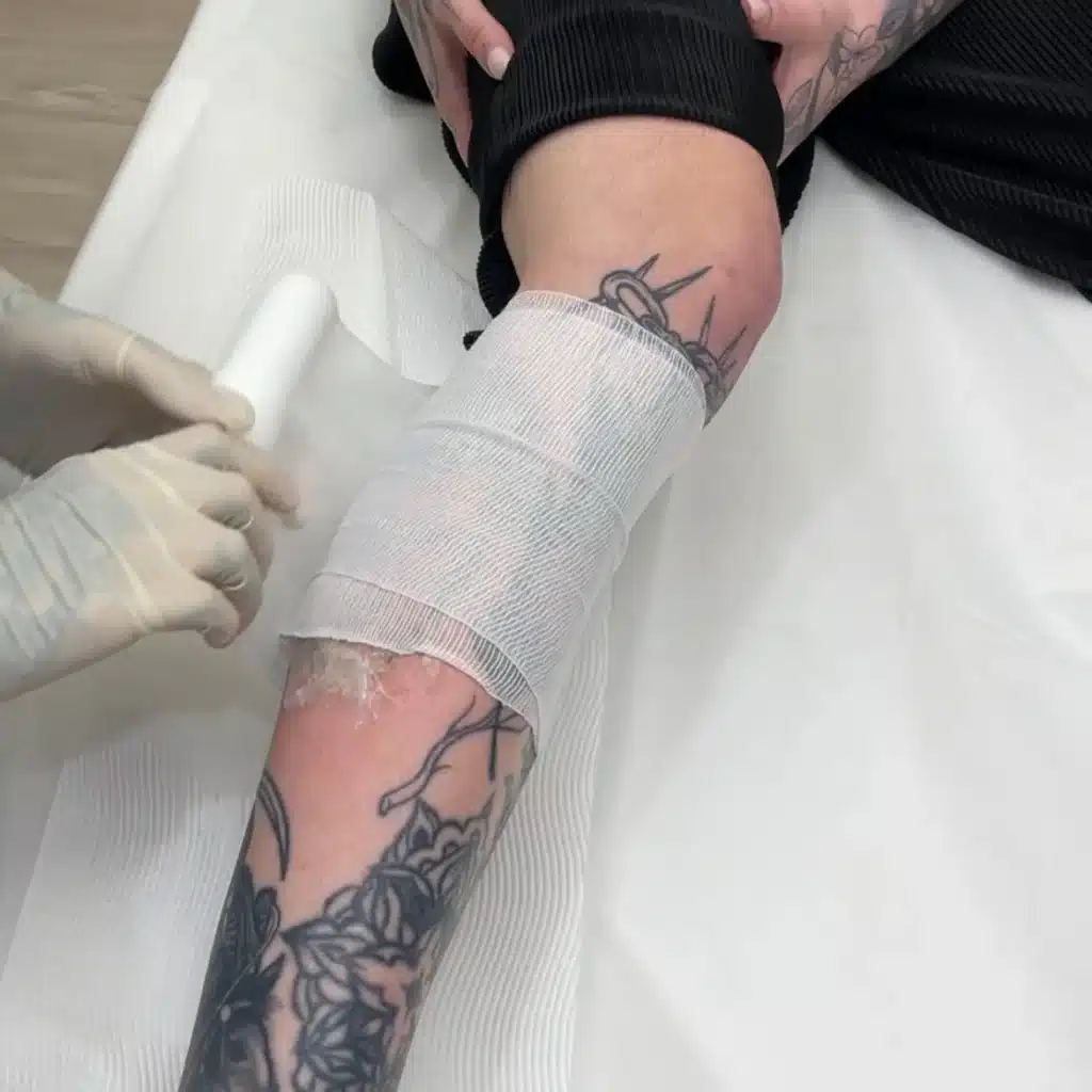 Laser Tattoo Removal Aftercare