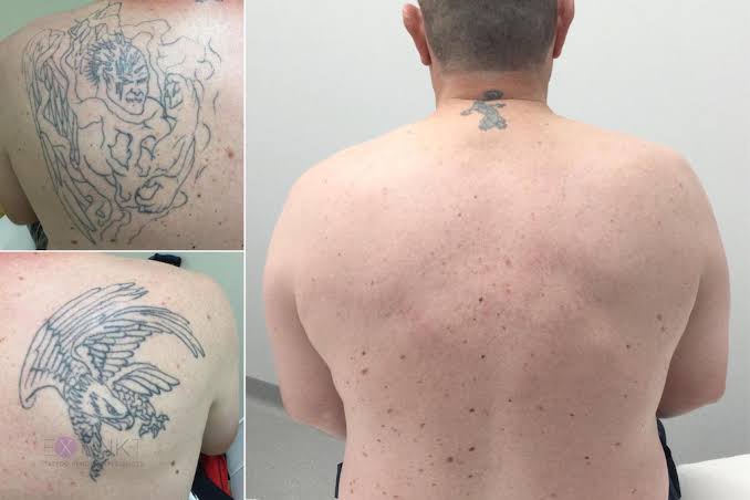 laser tattoo removal before and after dark ink vs colour tattoos