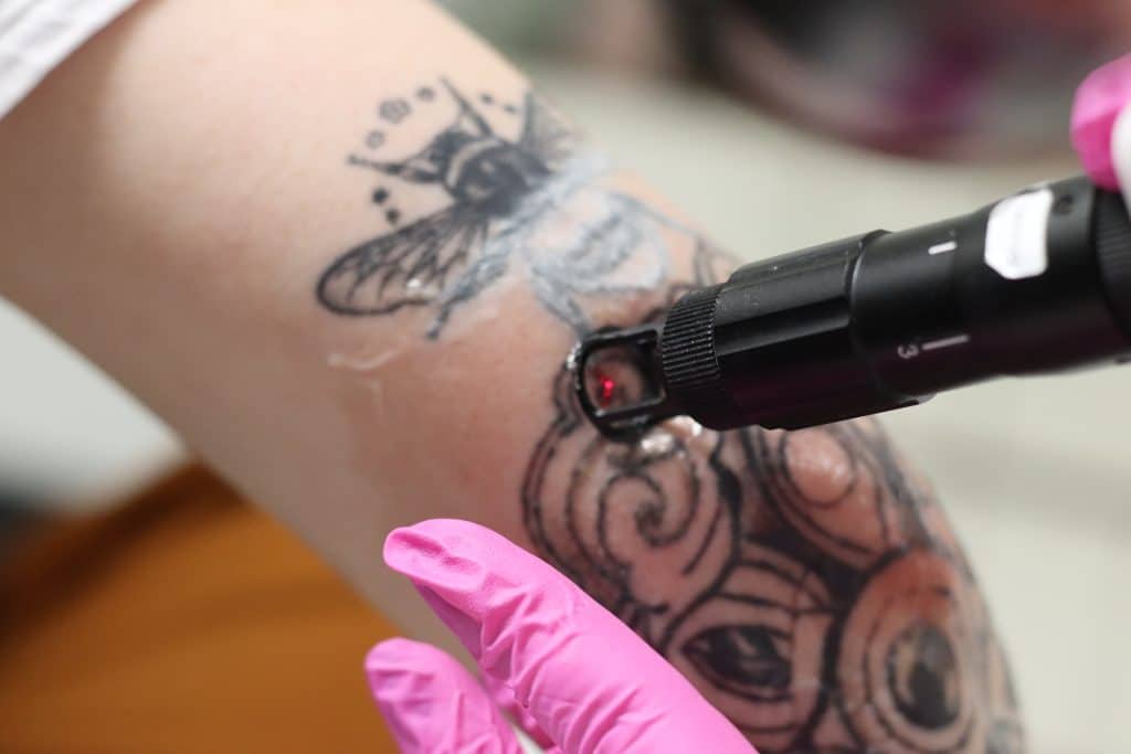laser tattoo removal cost breakdown