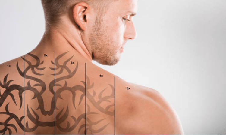Demystifying the Economics of Laser Tattoo Removal: An Authoritative Guide to Clinical Standards, Technology, and True Pricing