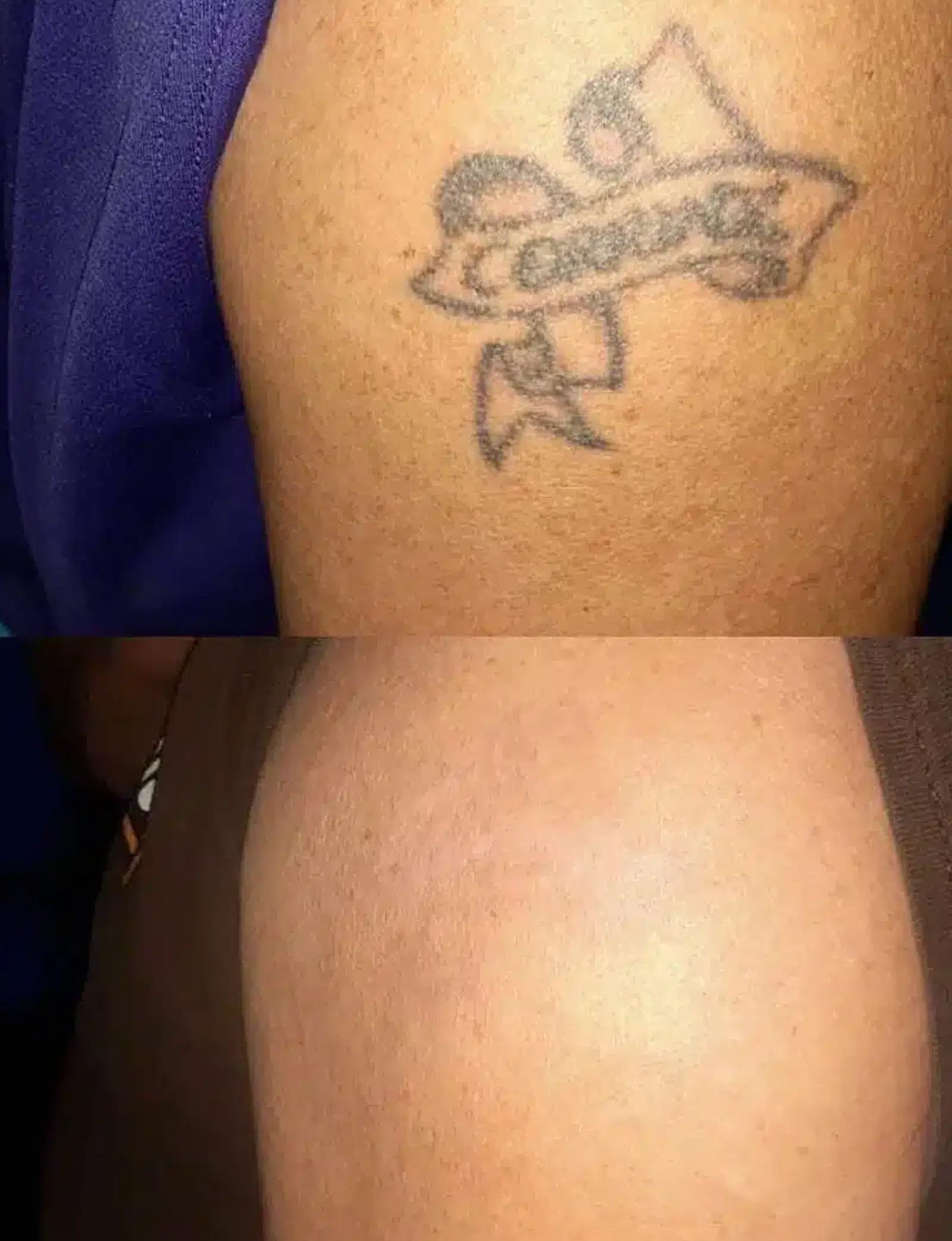 PFD Patch Laser Tattoo Removal