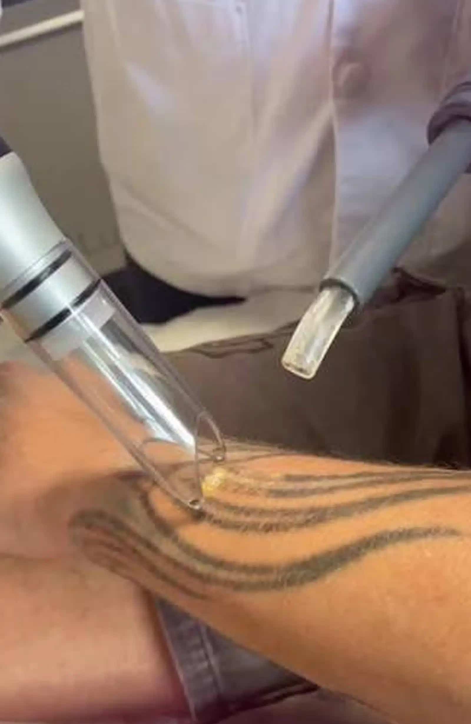 PFD Patch Laser Tattoo Removal