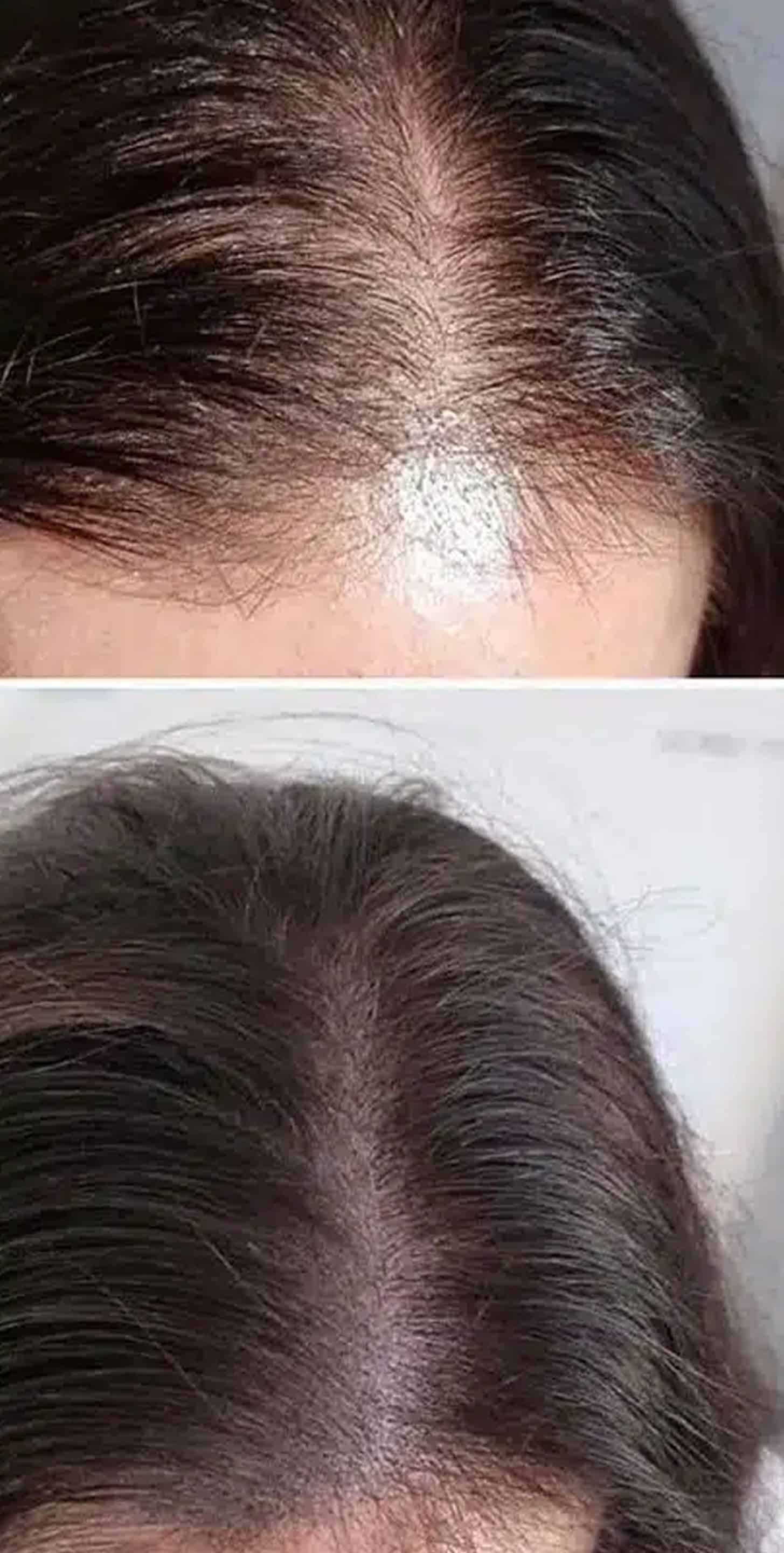 Scalp Micropigmentation