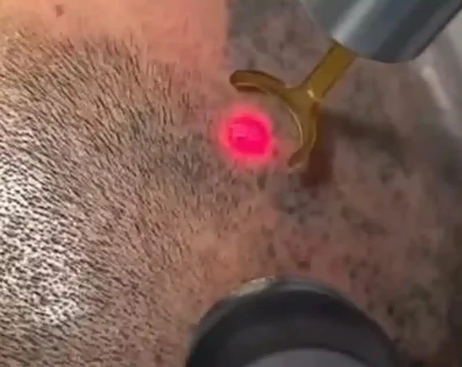 Scalp Pigmentation Removal