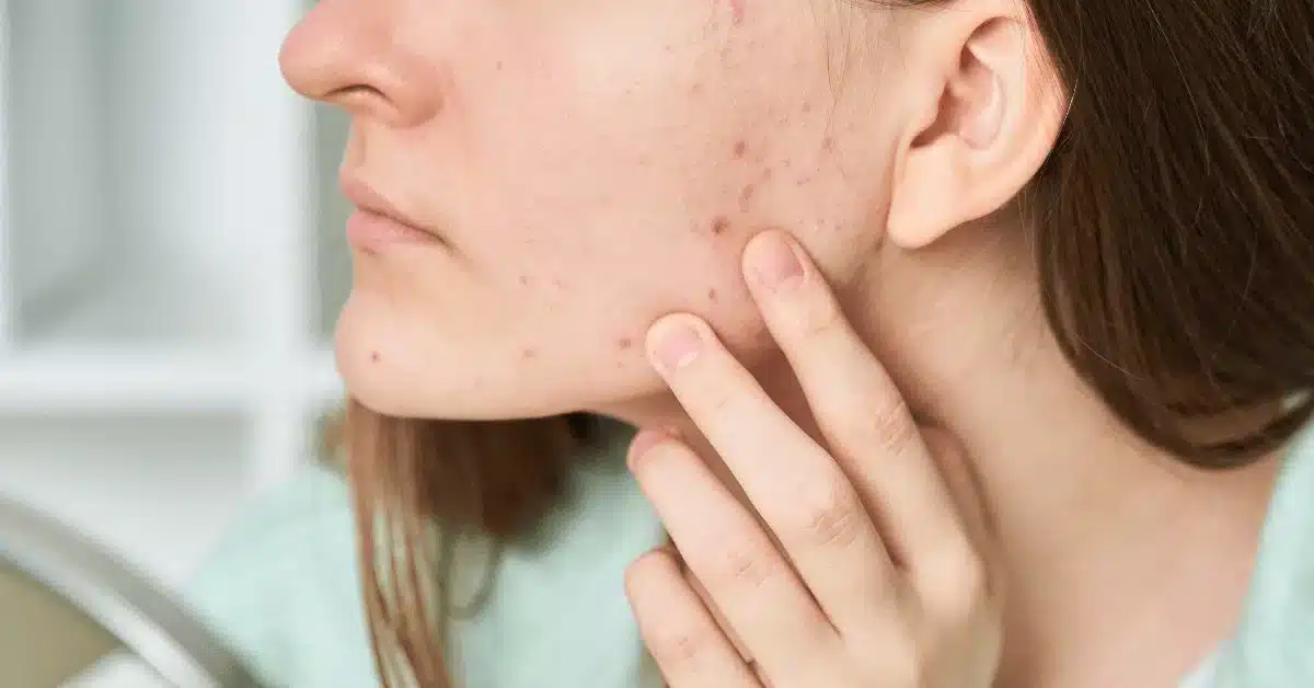 Scar Laser Treatment
