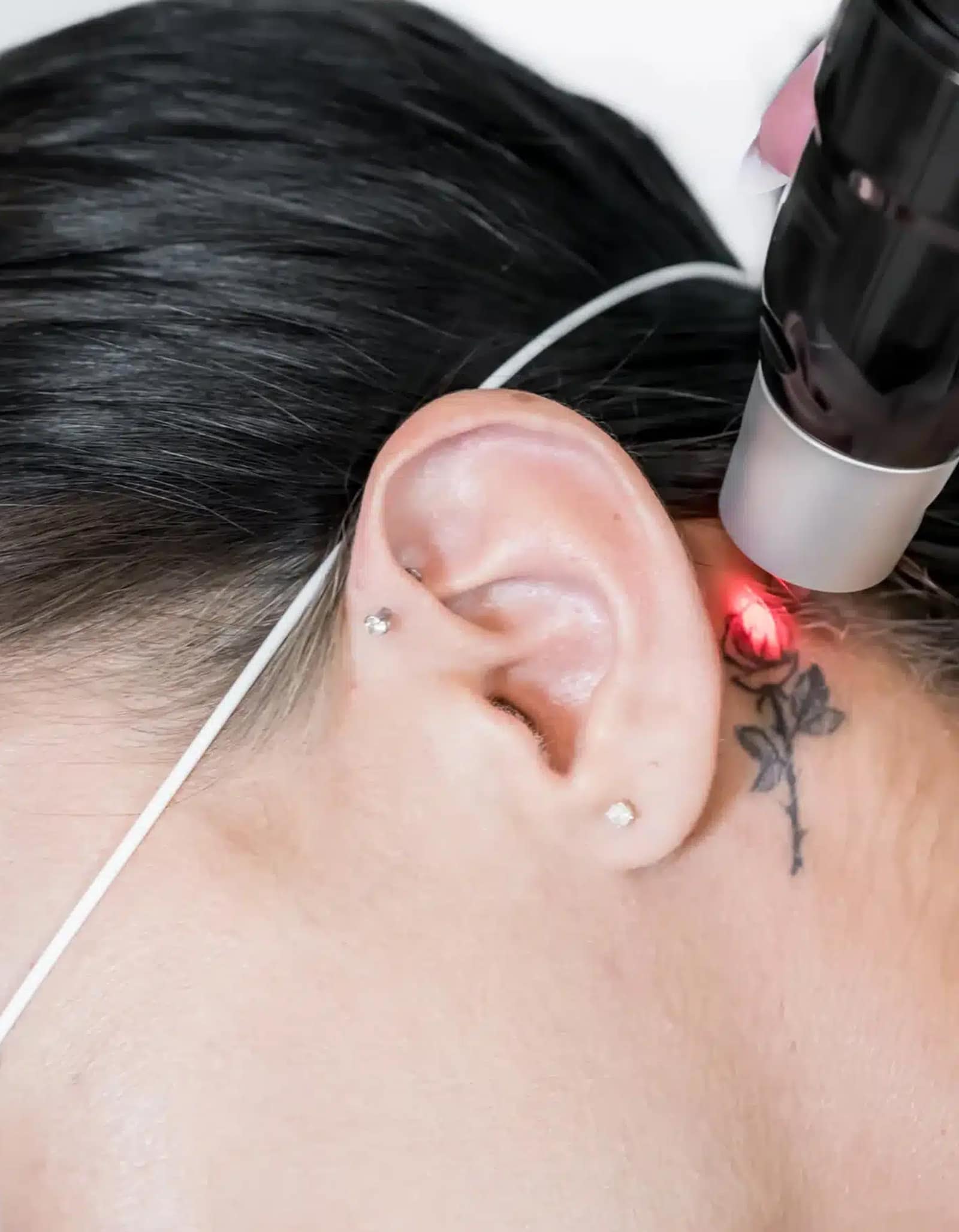 PFD Patch Tattoo Removal Procedure Works