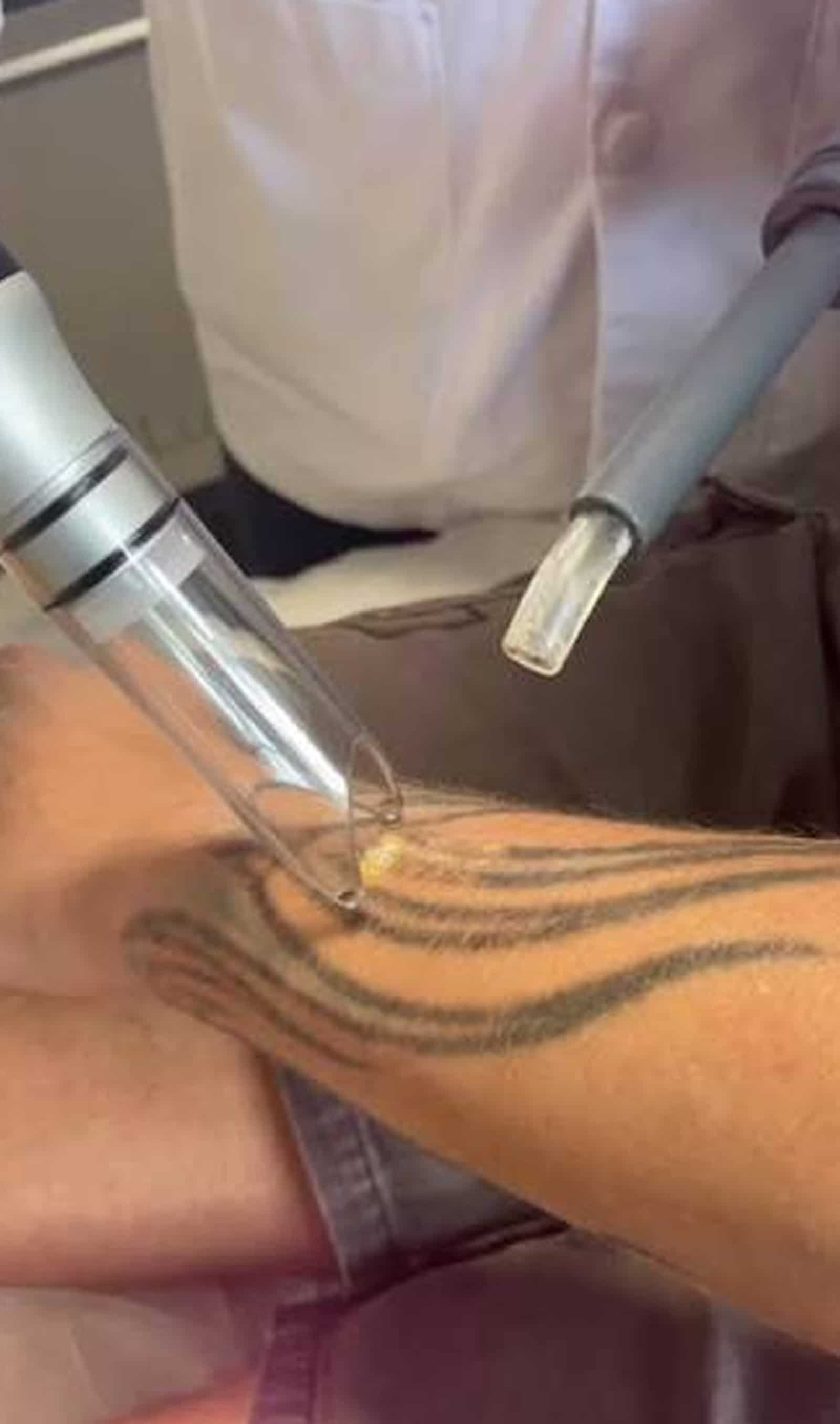 Winter Park Tattoo Removal