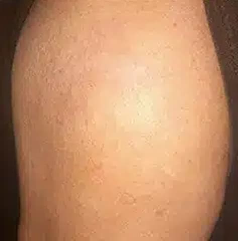Tattoo after laser tattoo removal treatments at Winter Park Tattoo Removal