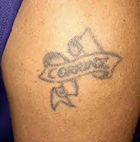 Tattoo before laser tattoo removal at Winter Park Tattoo Removal