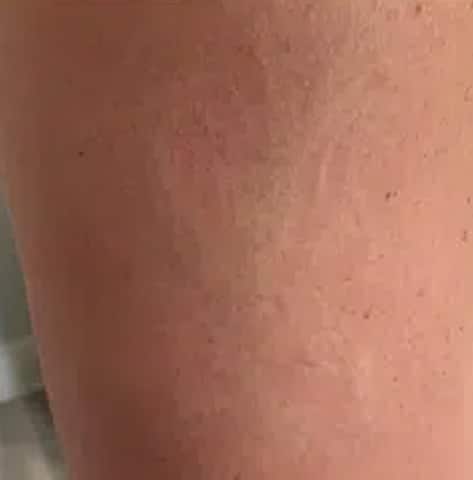 Tattoo after laser tattoo removal treatments at Winter Park Tattoo Removal