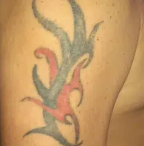 Tattoo before laser tattoo removal at Winter Park Tattoo Removal
