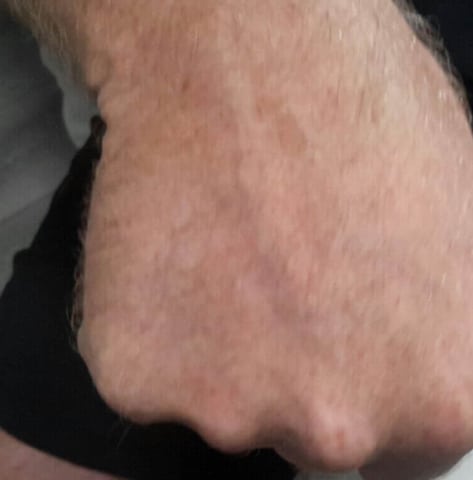 Tattoo after laser tattoo removal treatments at Winter Park Tattoo Removal
