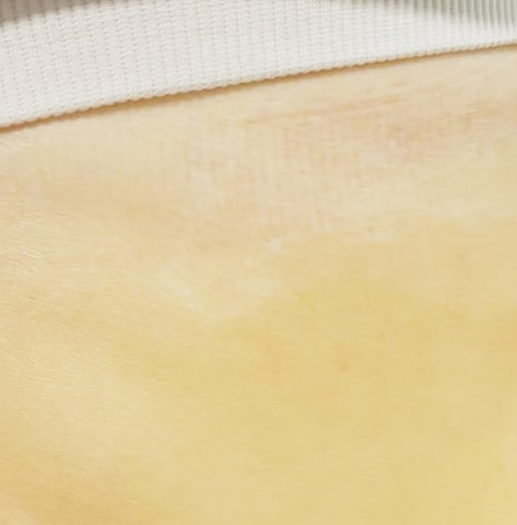 Tattoo after laser tattoo removal treatments at Winter Park Tattoo Removal