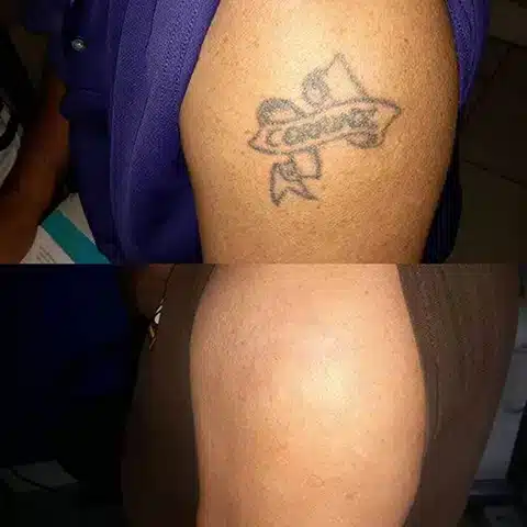 Winter Park Tattoo Removal Beforeafter (6) laser tattoo removal cost breakdown
