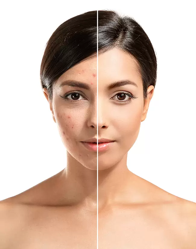 acne scar laser treatment orlando acne scar laser treatment orlando