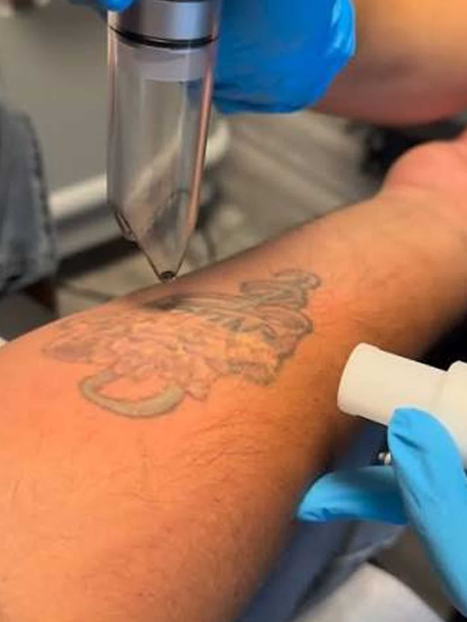 PFD Patch Tattoo Removal Safe