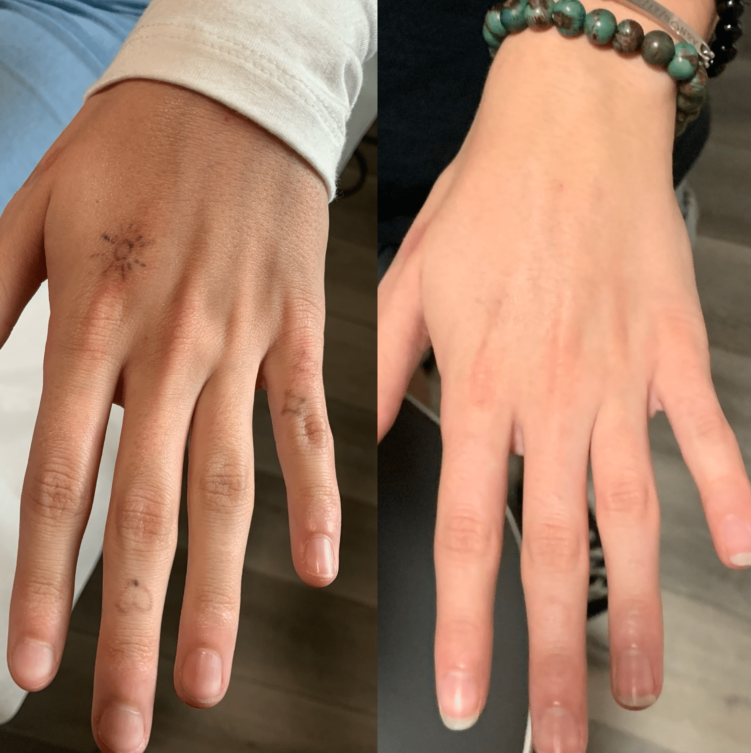 tattoo removal near me
