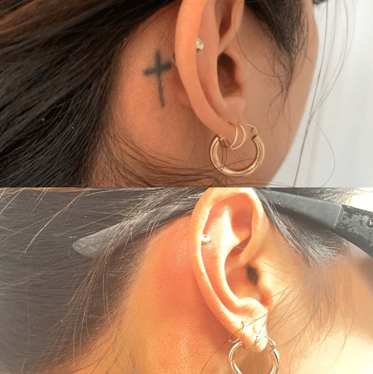 tattoo removal near me