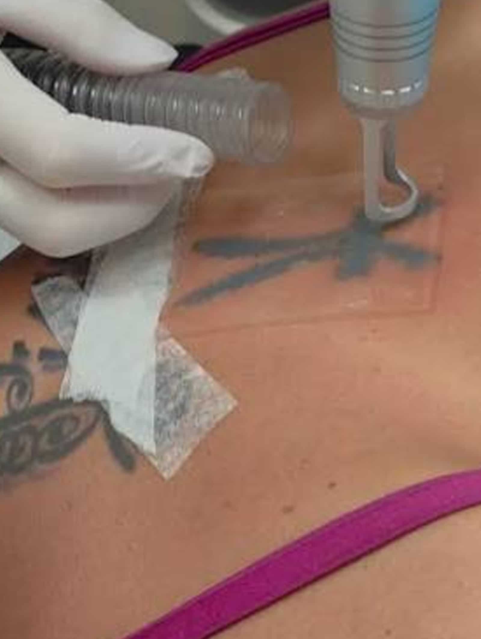 PFD Patch Laser Tattoo Removal