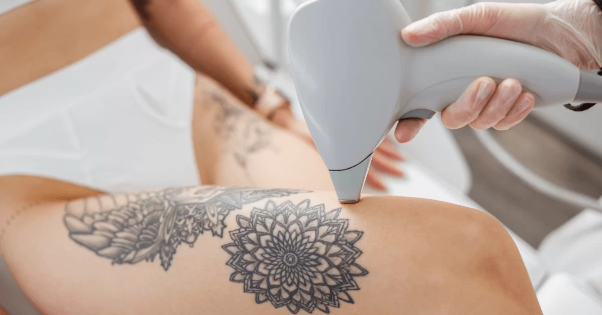 Laser Tattoo Removal with PicoSure® in Brisbane - b clinic